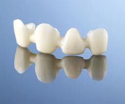 Alumina full porcelain denture crown